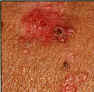 Basal Cell Carcinomas