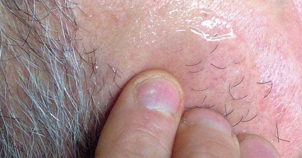 Patidegib topical gel phase 3 trial.
